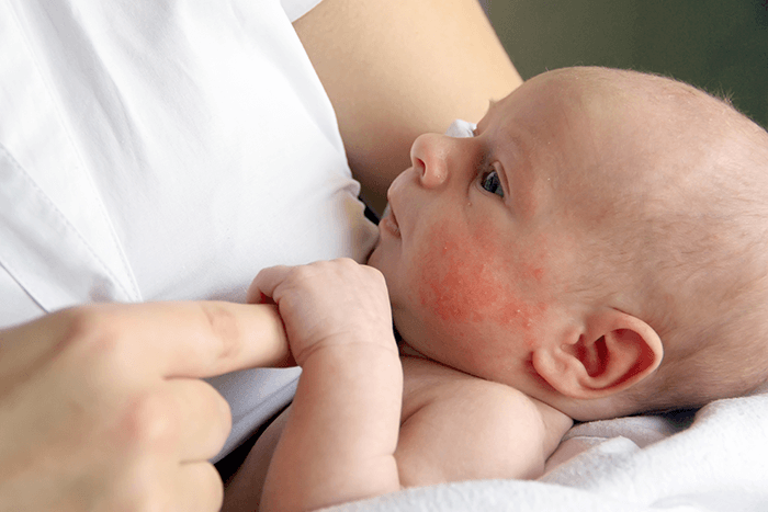 Alergia pokarmowa - czy to częste zjawisko?