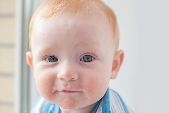 Zmiany skórne u niemowląt – jak łagodzić objawy uczuleń, egzemę i potówki?