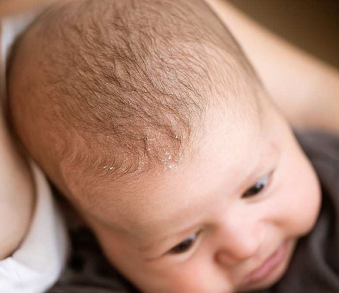 łupież czy łuszczyca jak rozróżnić te problemy skórne u niemowlęcia